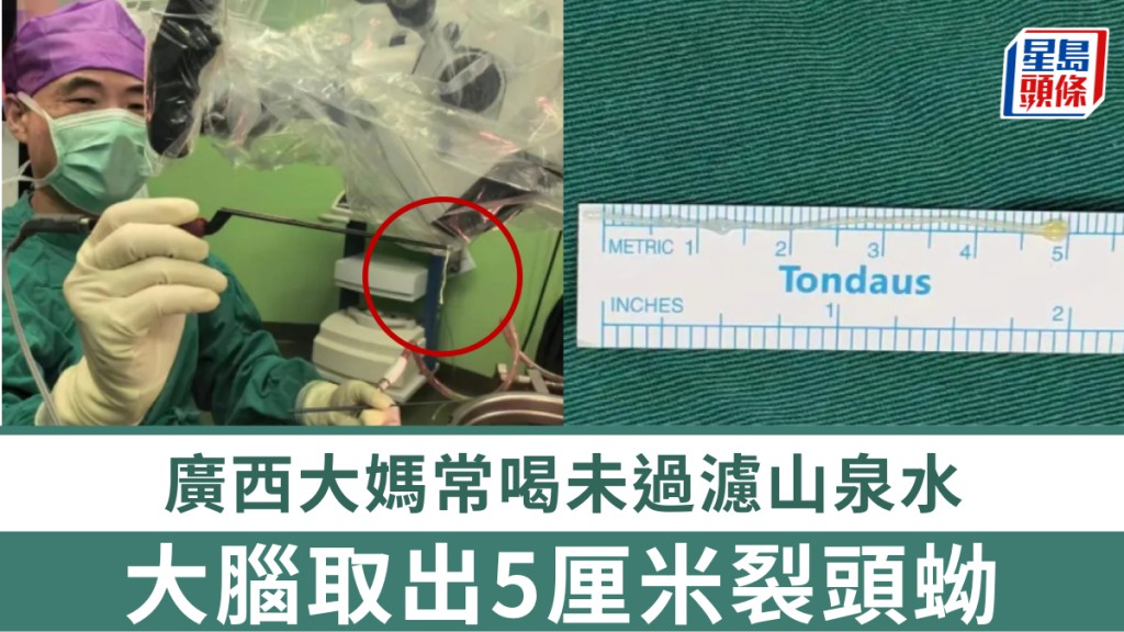 廣西大媽常喝未過濾山泉水，大腦取出5厘米裂頭蚴。
