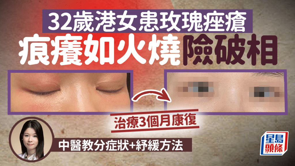 32歲港女患玫瑰痤瘡極痕癢險破相,治療3個月康復,中醫教紓緩方法。