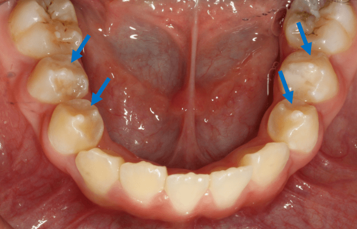 梁氏小臼齒患者的小臼齒上，長有脆弱的柱狀突出部分（箭咀示）。