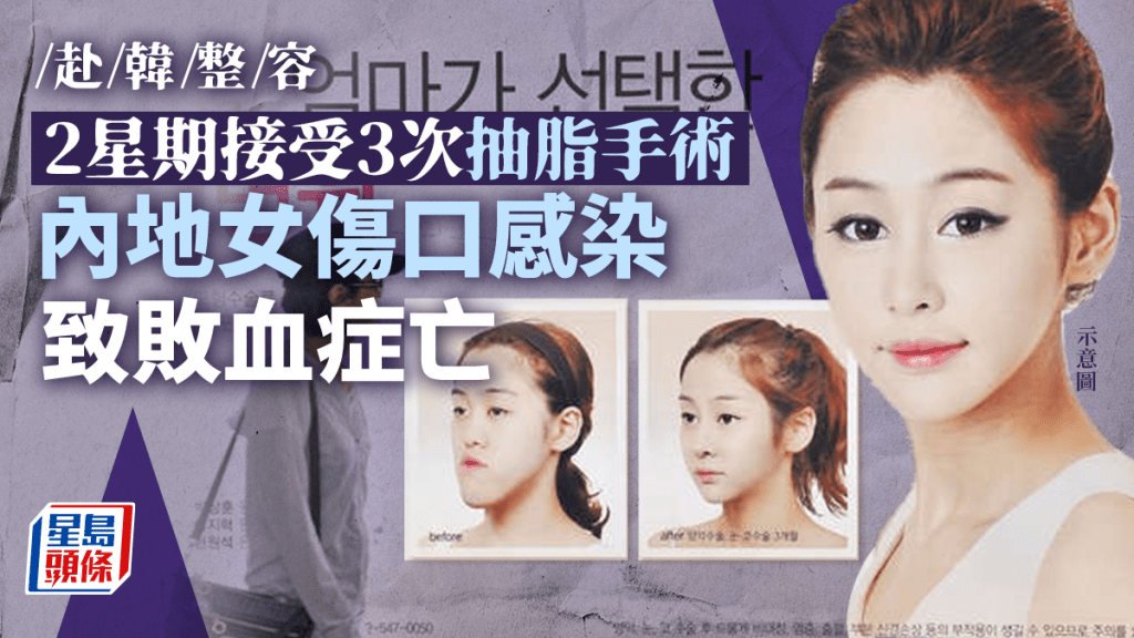 中國女子在南韓首爾接受抽脂手術 傷口感染肌肉腐爛慘死