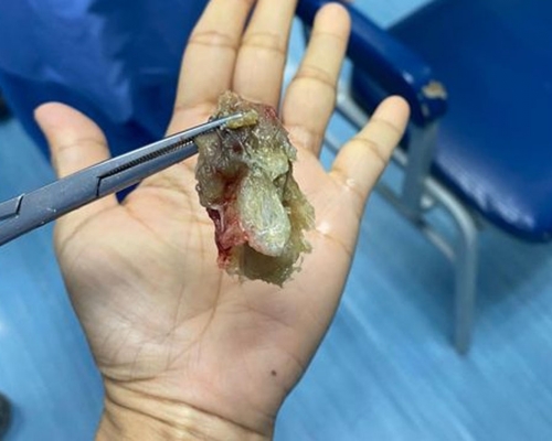 大馬醫生分享新冠患者因濃痰卡喉呼吸困難，手術時竟夾出如發霉鮑魚般的硬物。FB圖