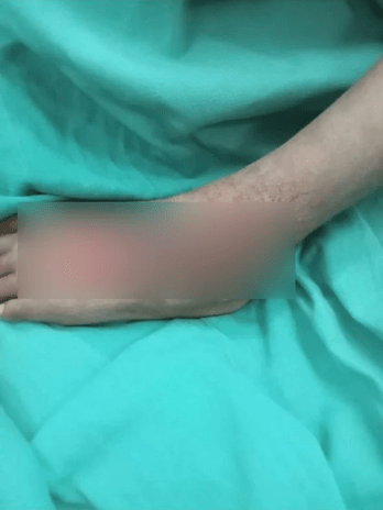 女童左脚被砸石，要做手术去除瘀血和脓液。