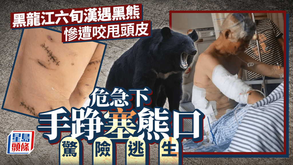 黑龍江六旬漢遇襲咬甩頭皮  手踭塞黑熊口脫險