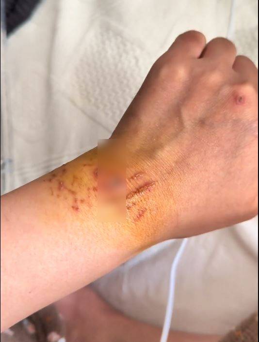 內地女遊客「大姨媽」到仍潛水，疑血腥味刺激鯊魚，導致手部被咬出血洞。抖音＠我愛藍色