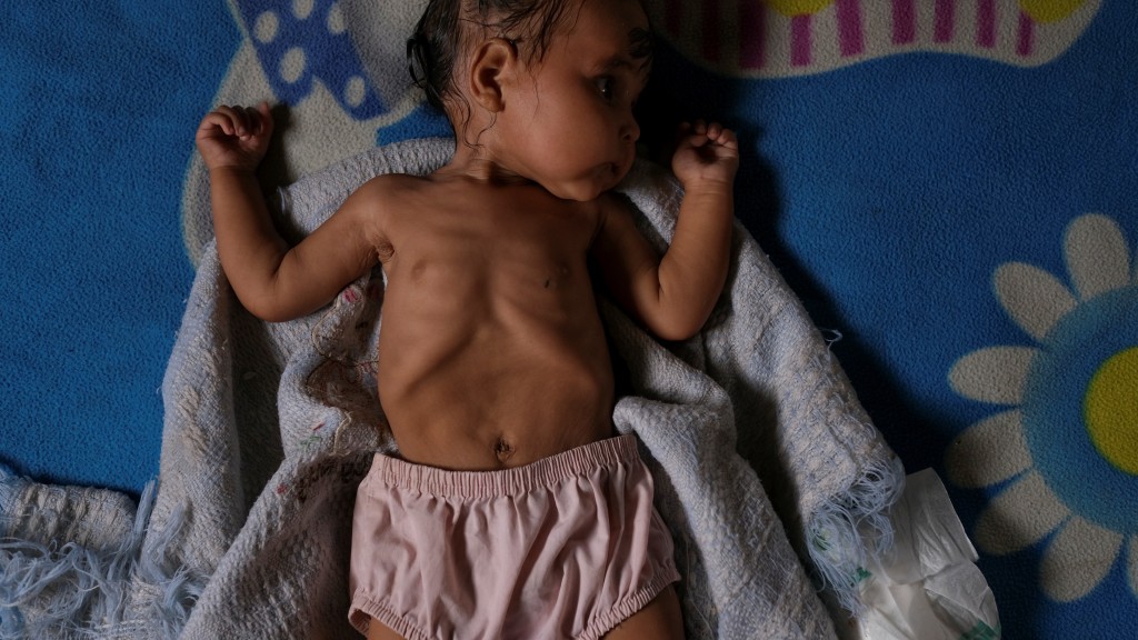 全球5岁以下儿童约有4500万人体重严重不足。 路透社