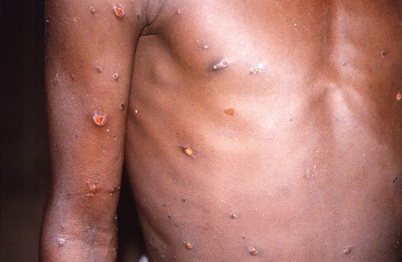 世衛收逾300宗猴痘確診或疑似病例報告。網圖