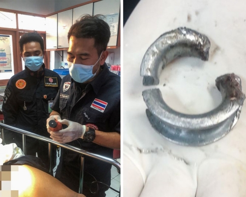 泰國男子為給女友驚喜，螺絲帽卡生殖器腫脹入院須動手術切割螺絲帽。（網圖） 