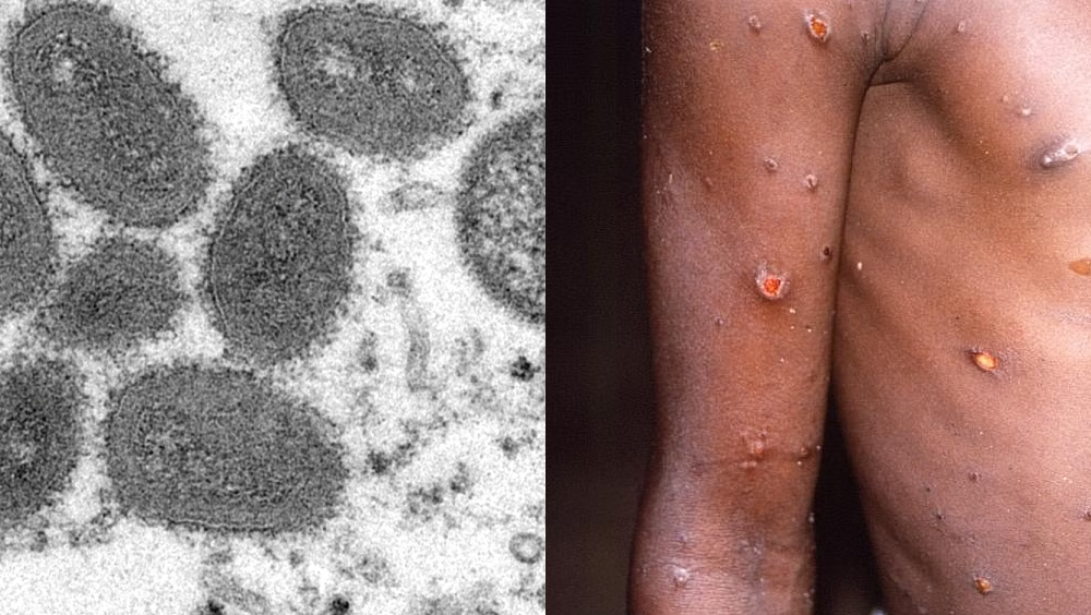 中疾控：11月新增80宗猴痘確診病例。 
