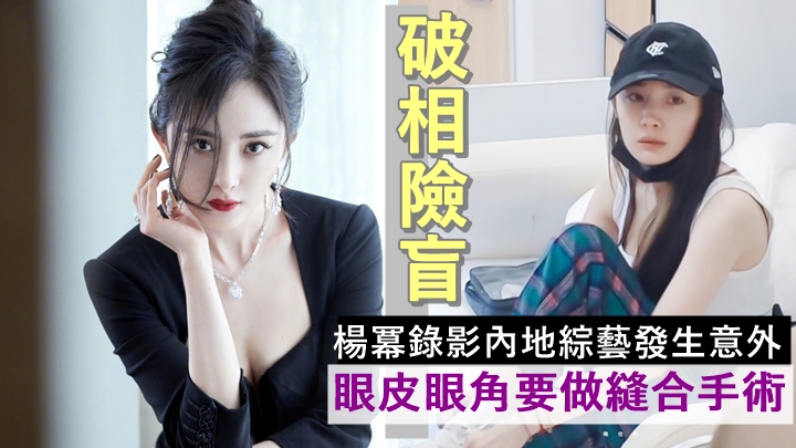 楊冪錄影綜藝發生意外破相險盲,眼皮眼角要做縫合手術。