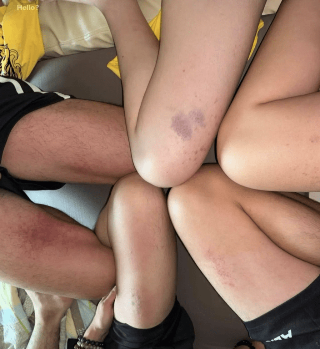 其中一張相片可見多名男女學生圍成一圈,各自拉起短褲及屈起腿部,向鏡頭展示大腿上的多處瘀痕。Threads圖片 其中一張相片可見多名男女學生圍成一圈,各自拉起短褲及屈起腿部,向鏡頭展示大腿上的多處瘀痕。Threads圖片