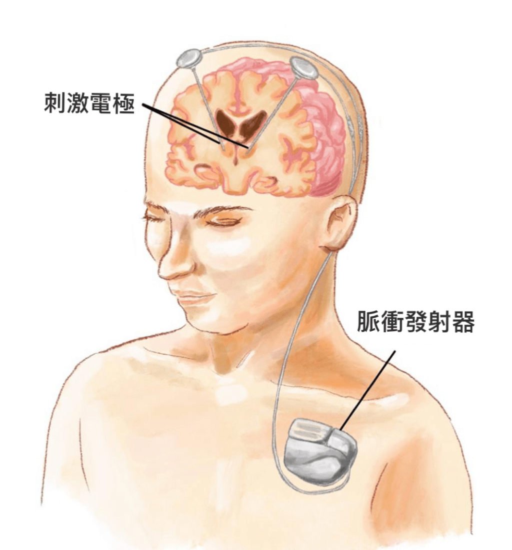 脑深部电刺激仪示意图。  复旦大学附属中山医院供图
