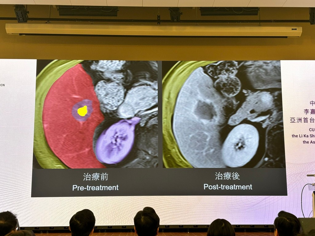 治療前後肝腫瘤完全消失。脫芷晴攝 治療前後肝腫瘤完全消失。脫芷晴攝