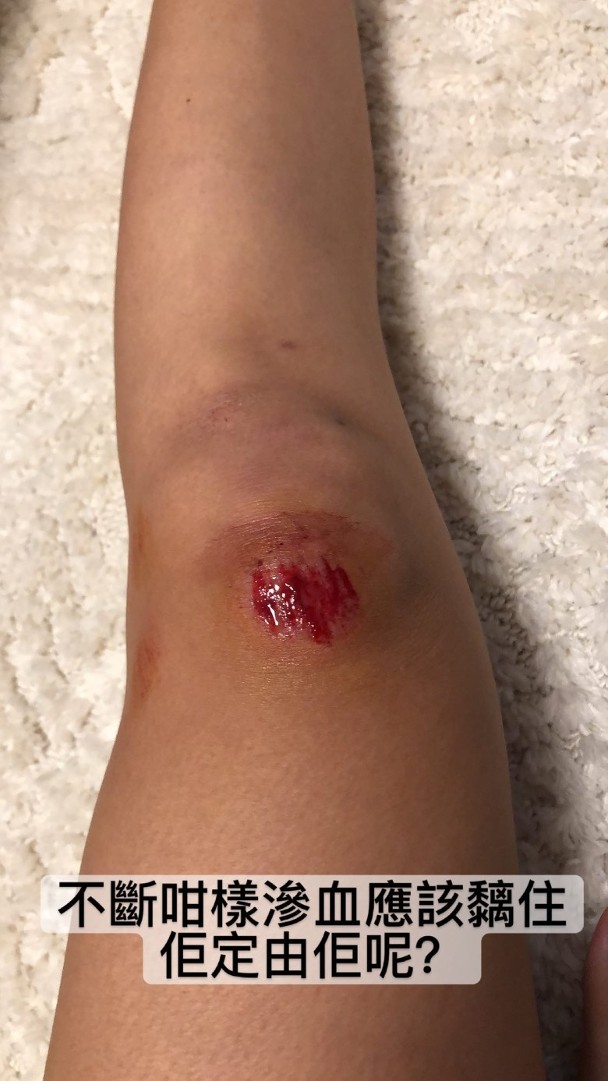 跑步擦損手腳。