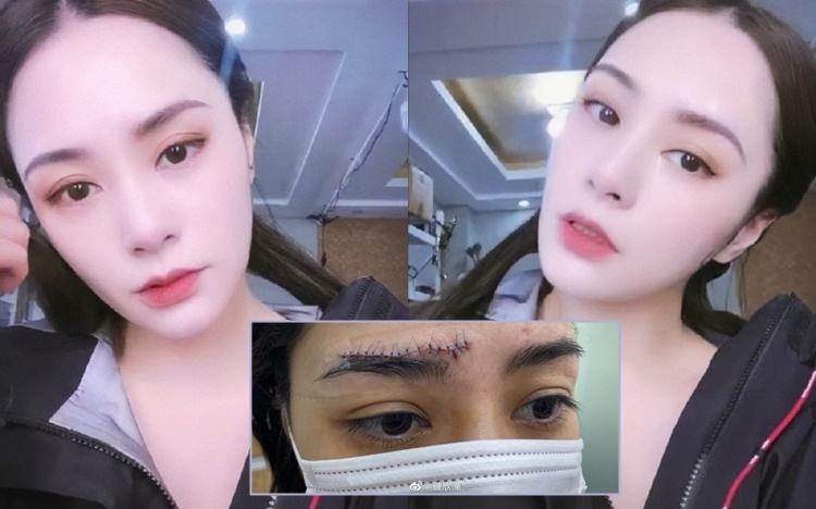 阿嬌眉骨嘅疤痕完全唔明顯,Fans可以鬆一口氣。