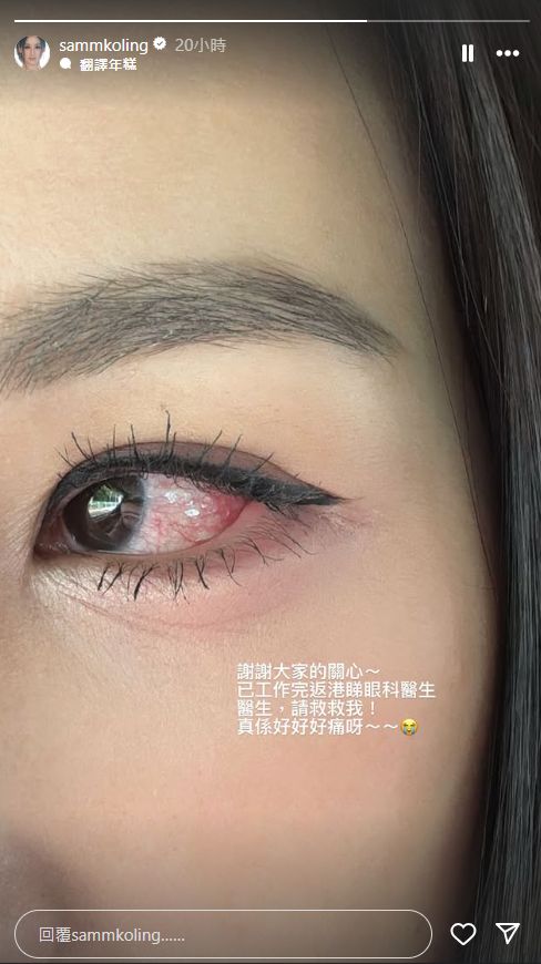 高海寧最新的限時動態見到雙眼佈滿紅筋。 高海寧最新的限時動態見到雙眼佈滿紅筋。