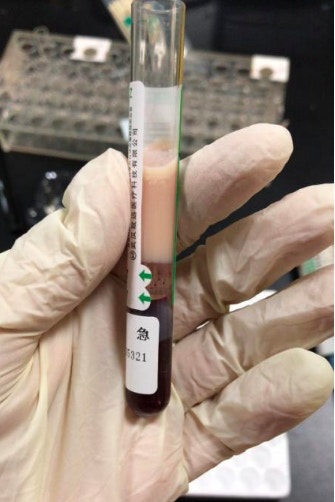 抽血时惊现「牛奶血」。网图