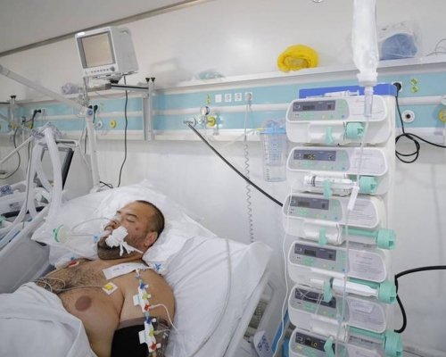 世衞公布新冠長期後遺症定義,康復者持續有健康問題。AP資料圖片