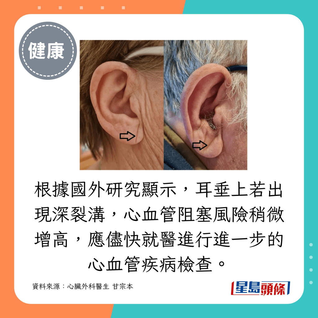 根據國外研究顯示，耳垂上若出現深裂溝，心血管阻塞風險稍微增高，應儘快就醫進行進一步的心血管疾病檢查。