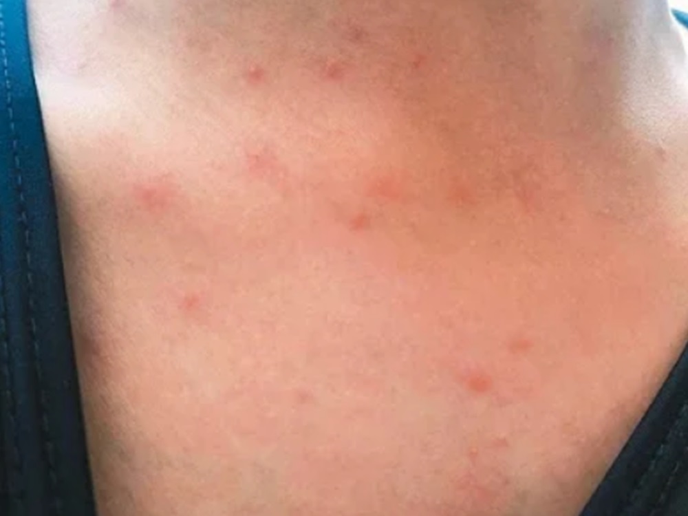 患者皮膚會出現紅疹及痕癢。網圖
