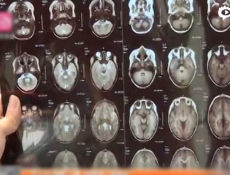 醫生指女童患有罕見遺傳病腦白質營養不良,此病症會影響其大腦和中樞神經系統,令她出現腦退化疾病和嚴重的癲癇等,而目前仍沒有特效治療方法。 網圖