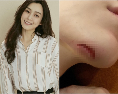 范瑋琪下巴受傷，需要縫15針。范瑋琪fb圖片