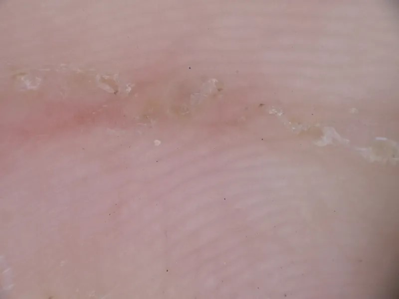 皮膚鏡下疥蟲爬行的「隧道」。