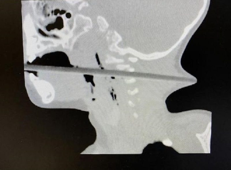 男童喉嚨被筷子貫穿。網上圖片