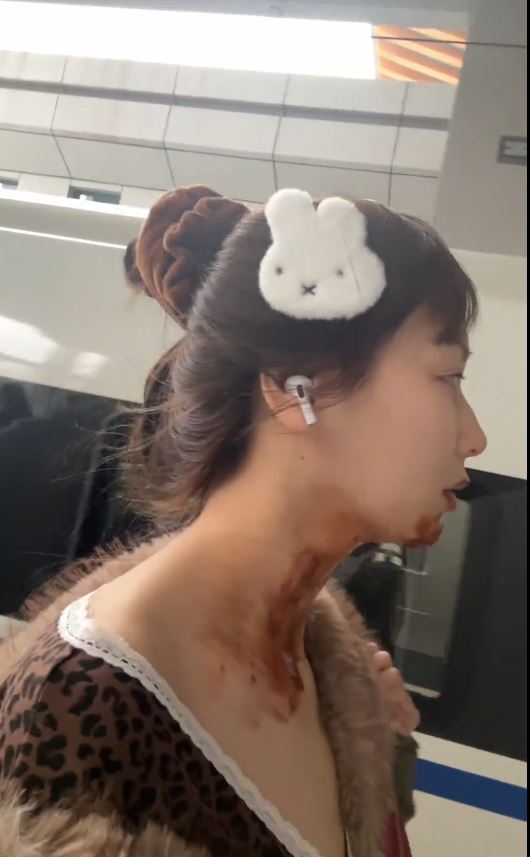 王添羽模仿喷火蛋糕遭回流火焰烧伤。抖音