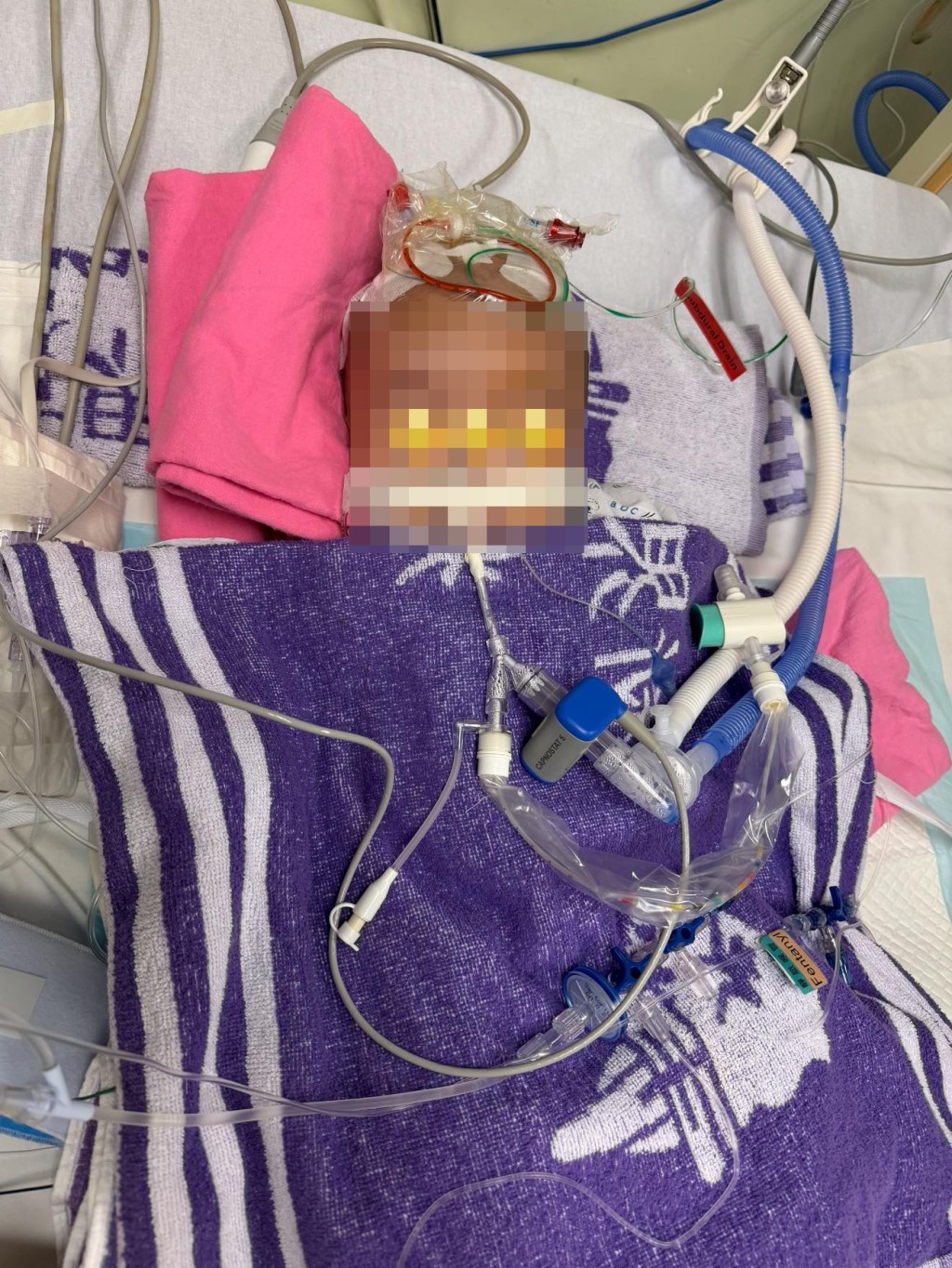 盧先生指兒子「細波」早前已接受手術，現時留醫兒童深切治療部。網上圖片