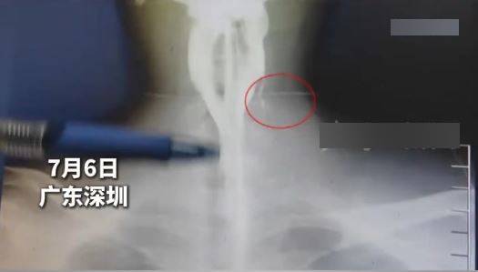 阿偉20年前吃瓜子卻有7粒「走去」頸部，近日他膿腫脹痛才發現。新晚報