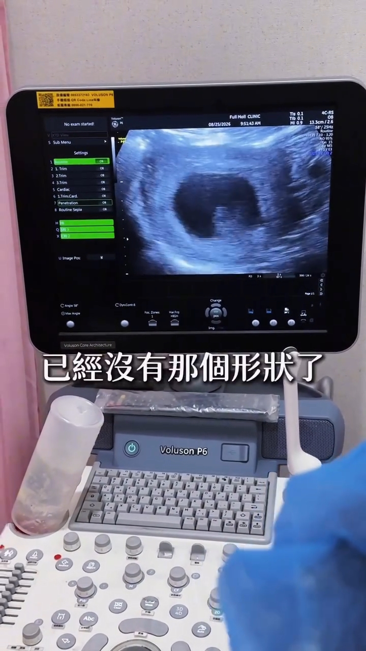 李宓今日再產檢,連原本寶寶的形狀,已經看不清楚了。 李宓今日再產檢,連原本寶寶的形狀,已經看不清楚了。