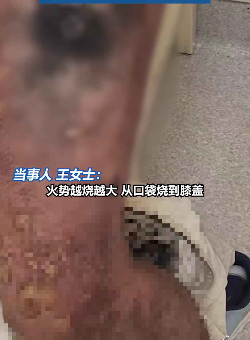 上海一男子褲袋羅馬仕「尿袋」自燃,致腿部三級燒傷,需植皮。 後浪視頻 上海一男子褲袋羅馬仕「尿袋」自燃,致腿部三級燒傷,需植皮。 後浪視頻