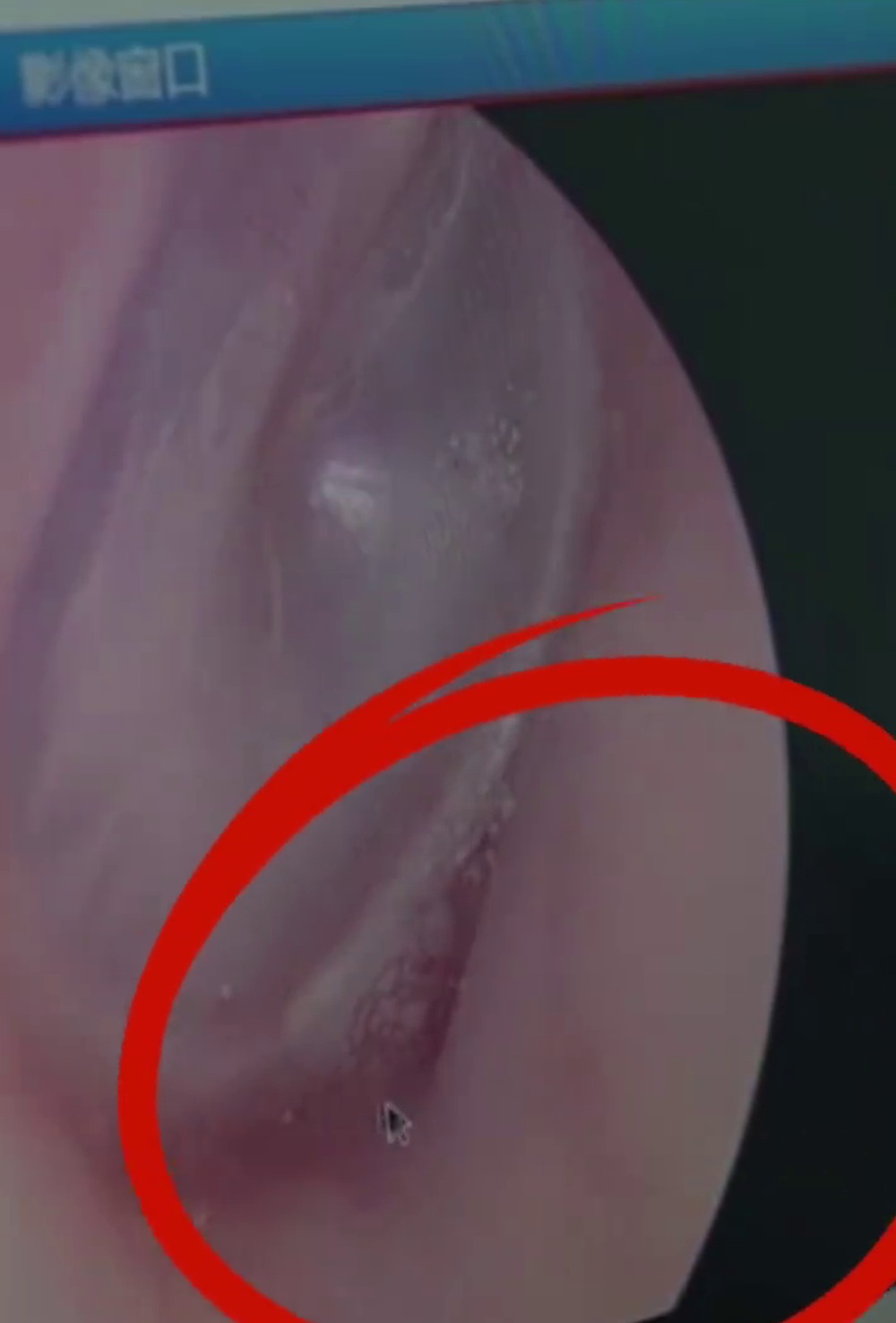 医生用耳镜发现女病人鼓膜上有疑似虫卵样的白色小颗粒。