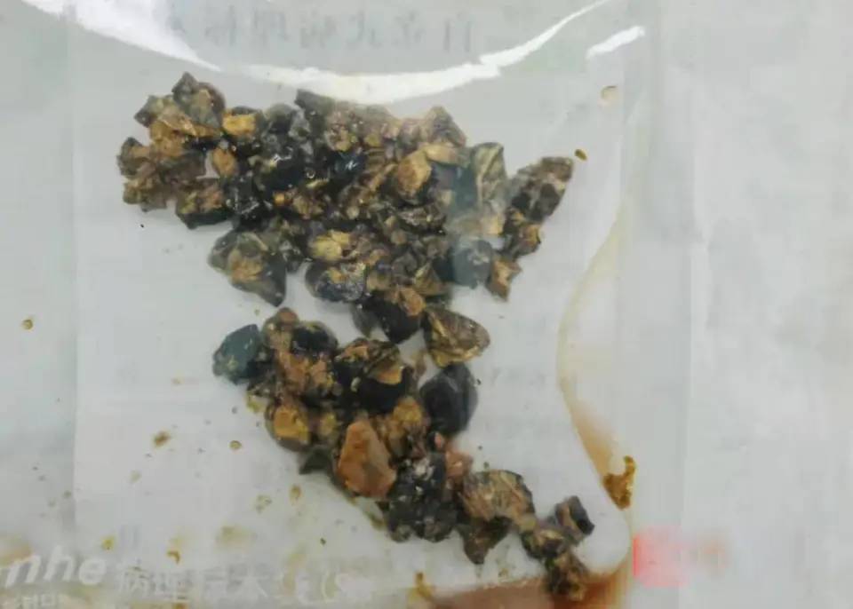 王女體內取出膽囊結石，竟多達60餘粒。 紫牛新聞