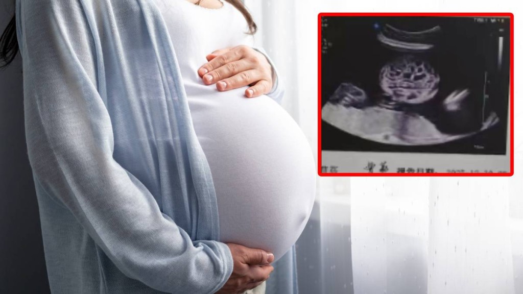 南京有孕婦產檢時發現胎兒(小圖)在子宮內已肚屙。iStock