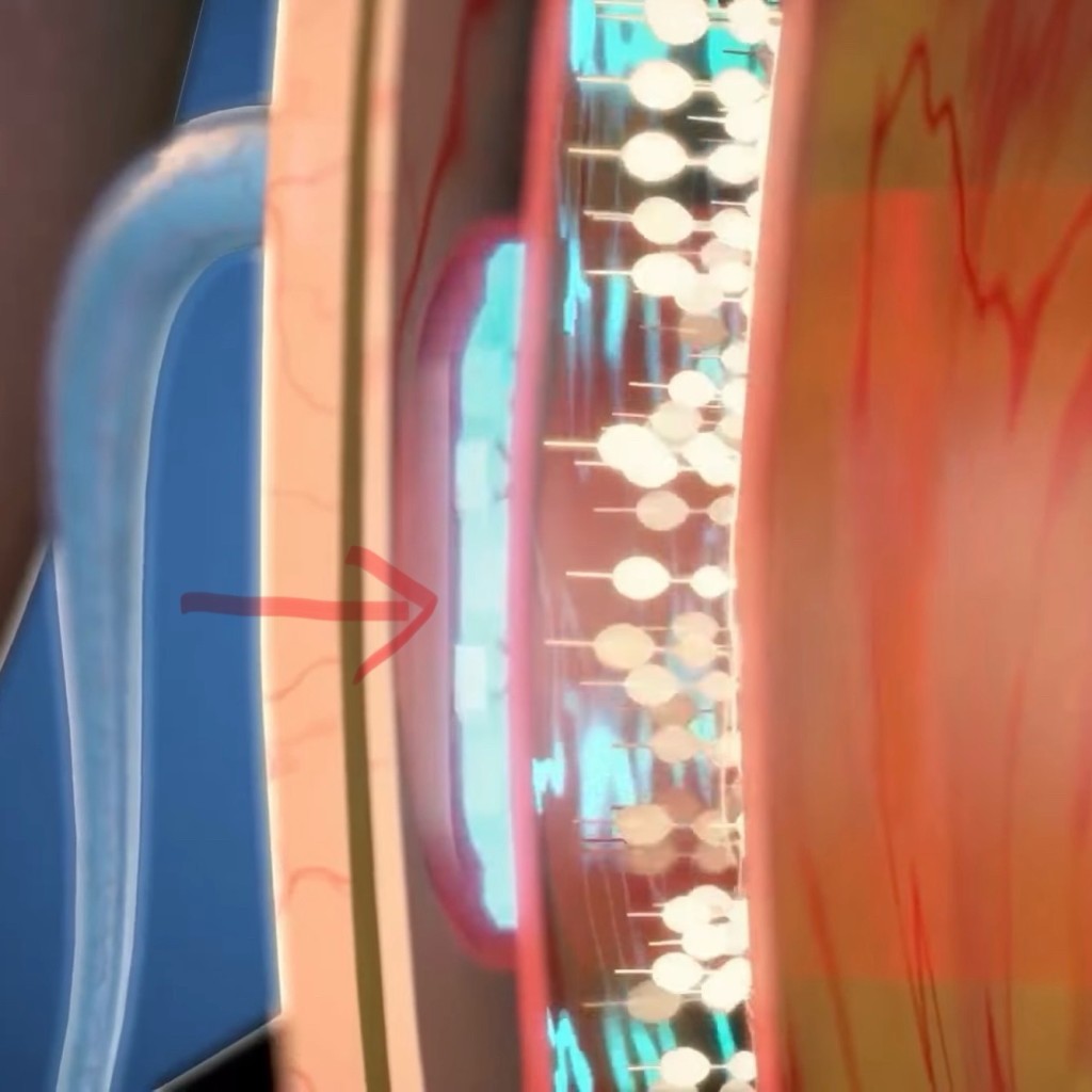 AI處理接收到的訊息，通過視網膜細胞和視神經傳入大腦。  Moorfields Eye Hospital NHS Foundation Trust