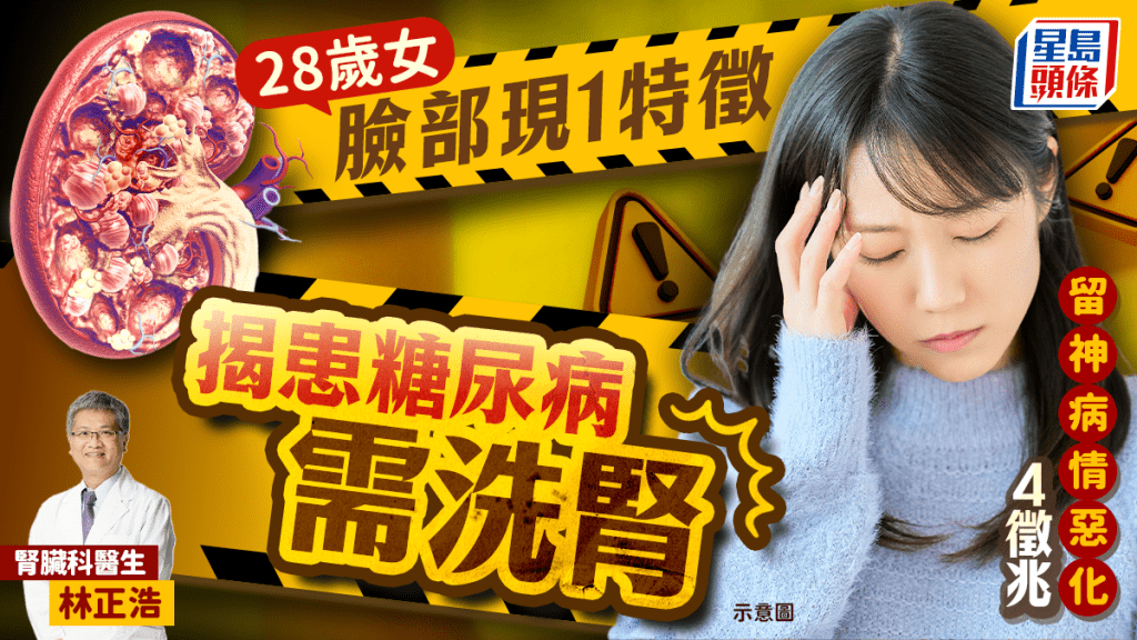 28歲女臉部現1特徵揭患糖尿病需洗腎 留神病情惡化4徵兆
