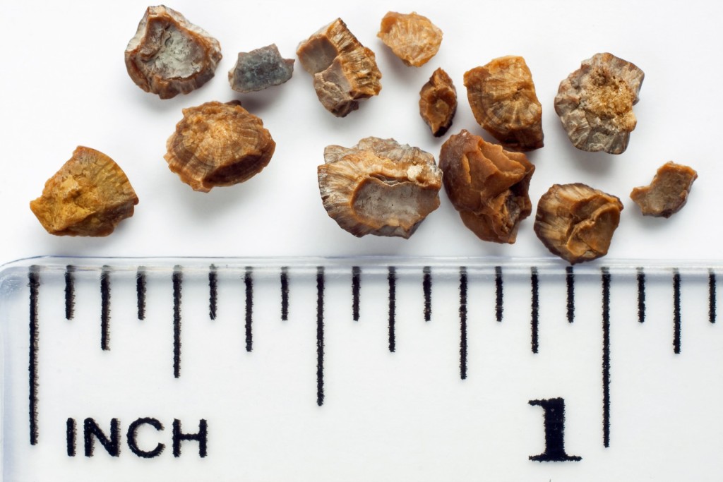 常見的腎石有一至兩厘米大。