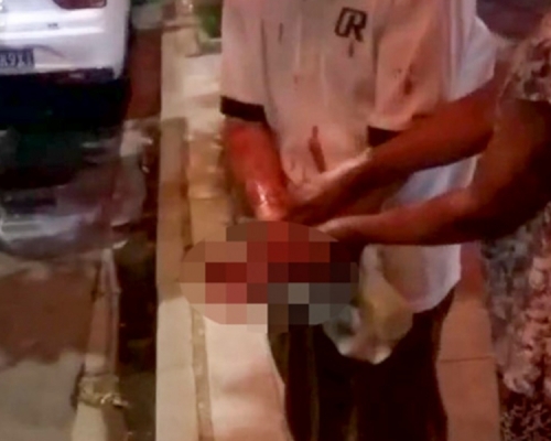老翁的左手掌被炸得血肉模糊。網圖