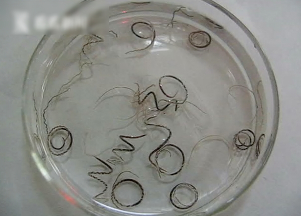 男子因長年喝生水腦中長滿寄生蟲。網圖