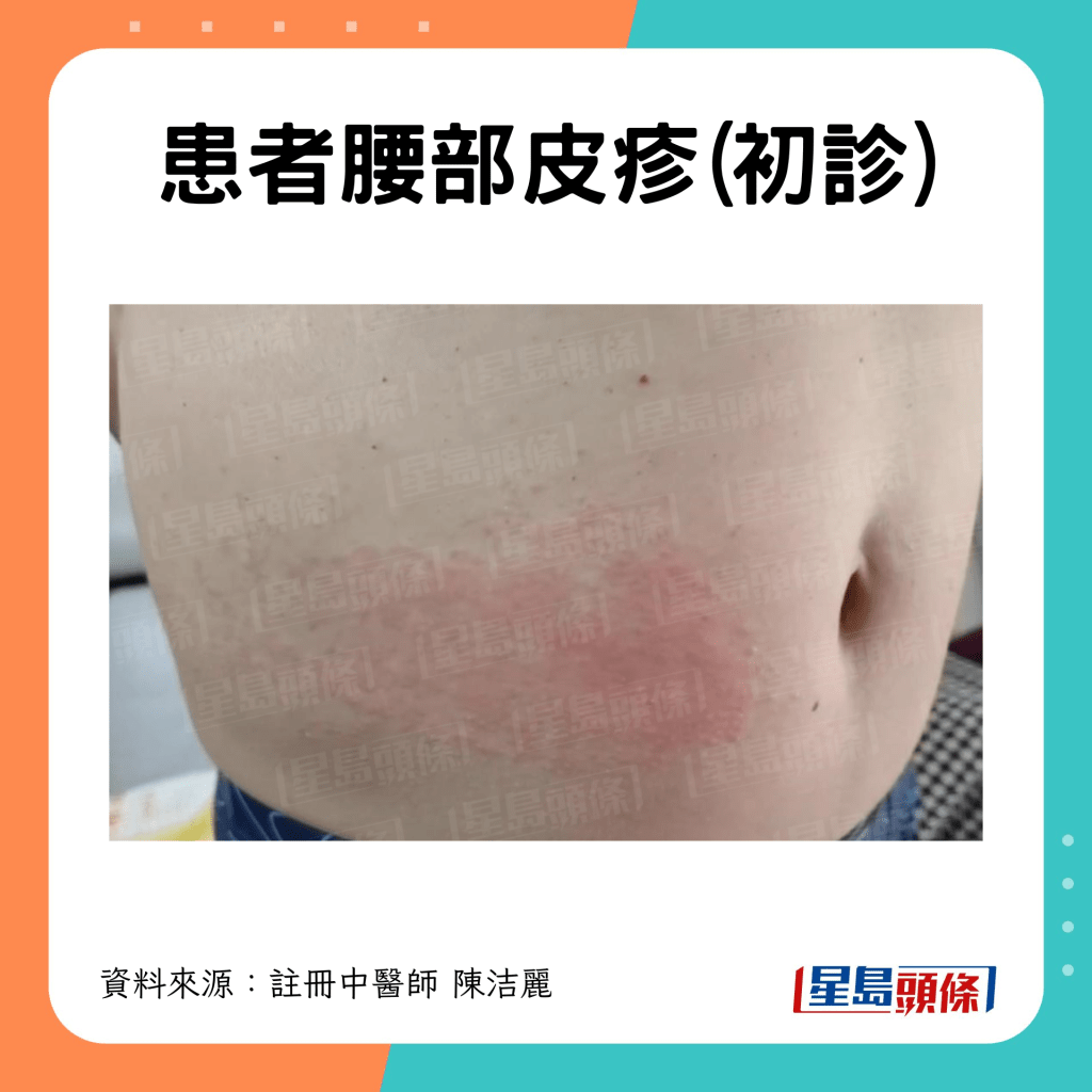 初診時腰部皮疹