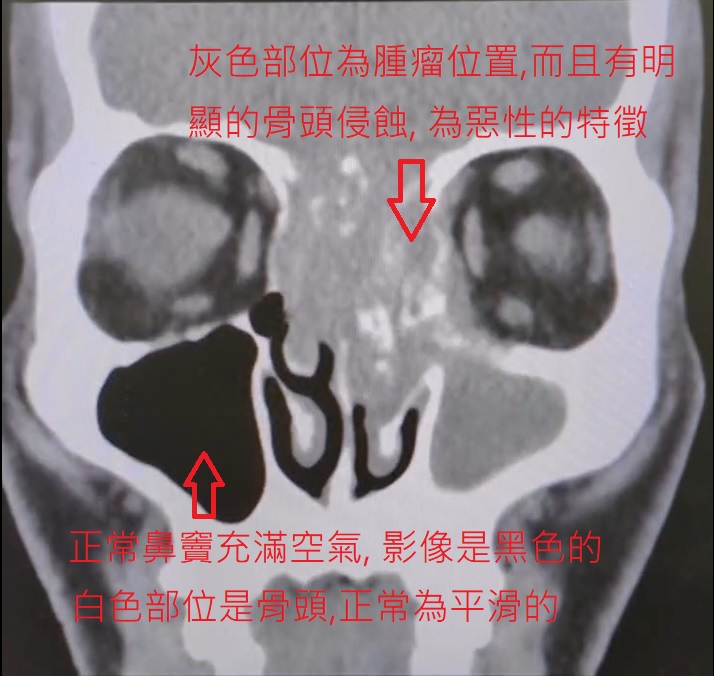 患者的电脑断层结果影像。（图片来源：陈亮宇医师 / 陈亮宇耳鼻喉科诊所）
