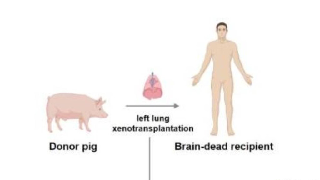 中國團隊將基因編輯豬肺成功移植人體。新華社