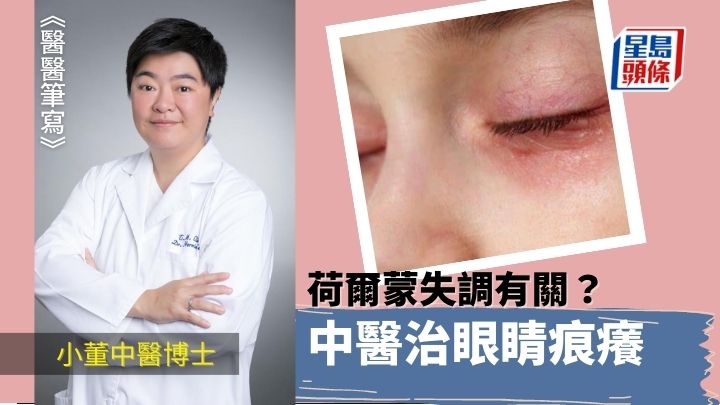 中醫治眼睛痕癢 女性荷爾蒙失調有關？｜醫醫筆寫