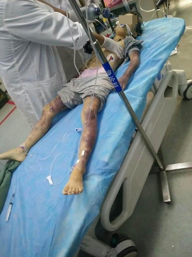 醫生看到女童傷勢形容是他執醫生涯16年中最痛心的場景。（網圖）