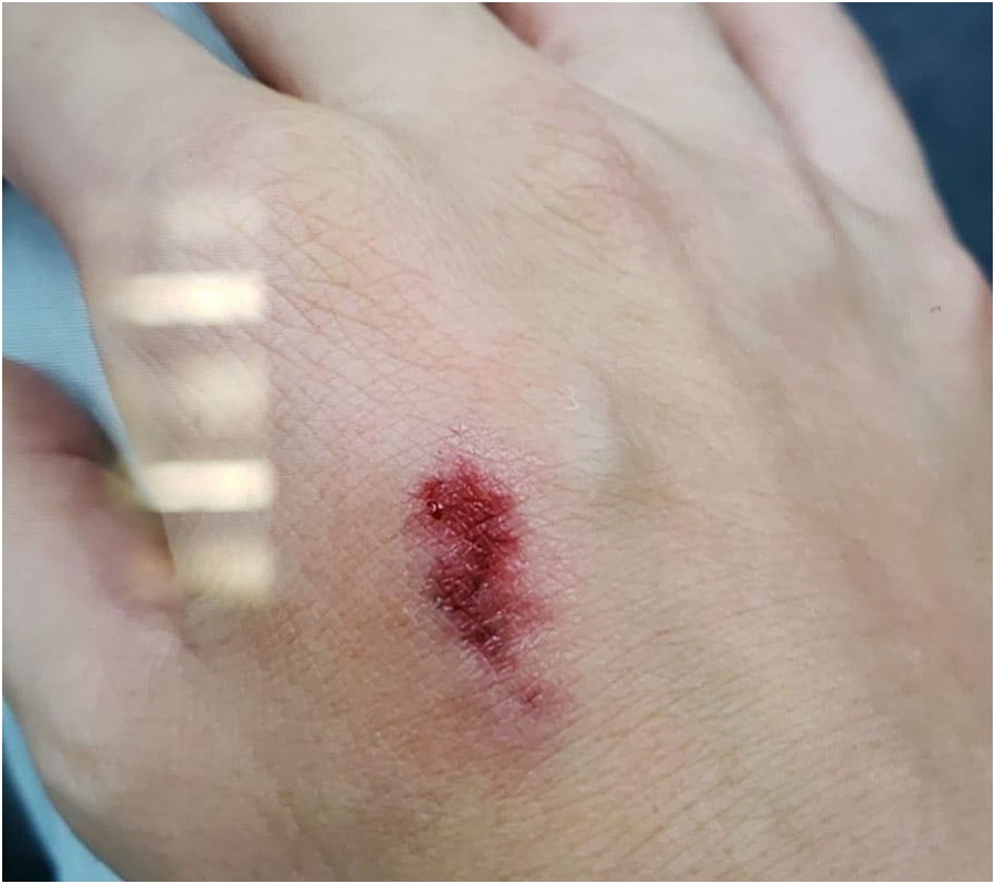 入境處女職員被咬傷