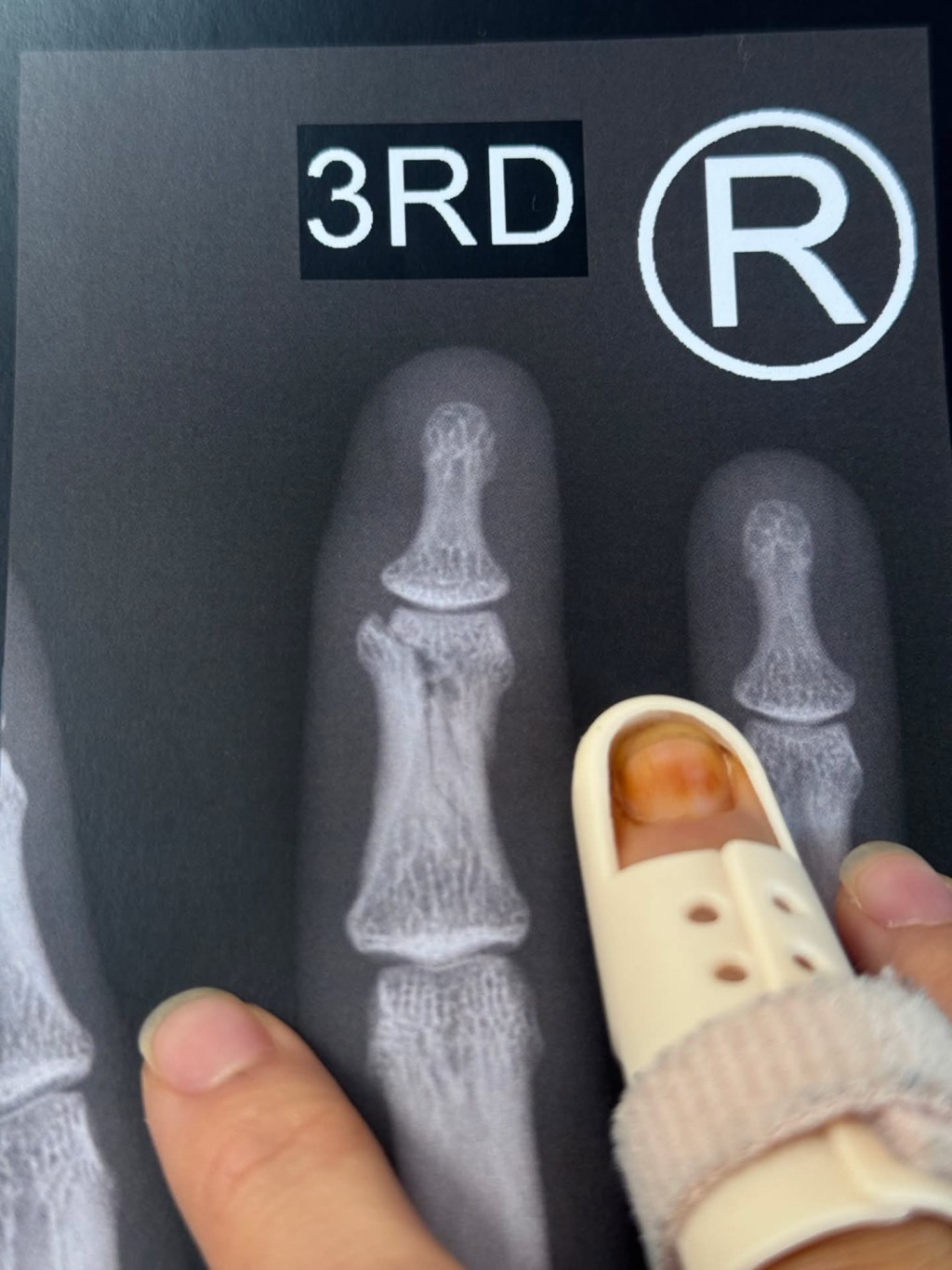 其中一名女受害人在社交平台表示,與疑犯拉扯期間,手指嚴重受傷。Threads截圖 其中一名女受害人在社交平台表示,與疑犯拉扯期間,手指嚴重受傷。Threads截圖