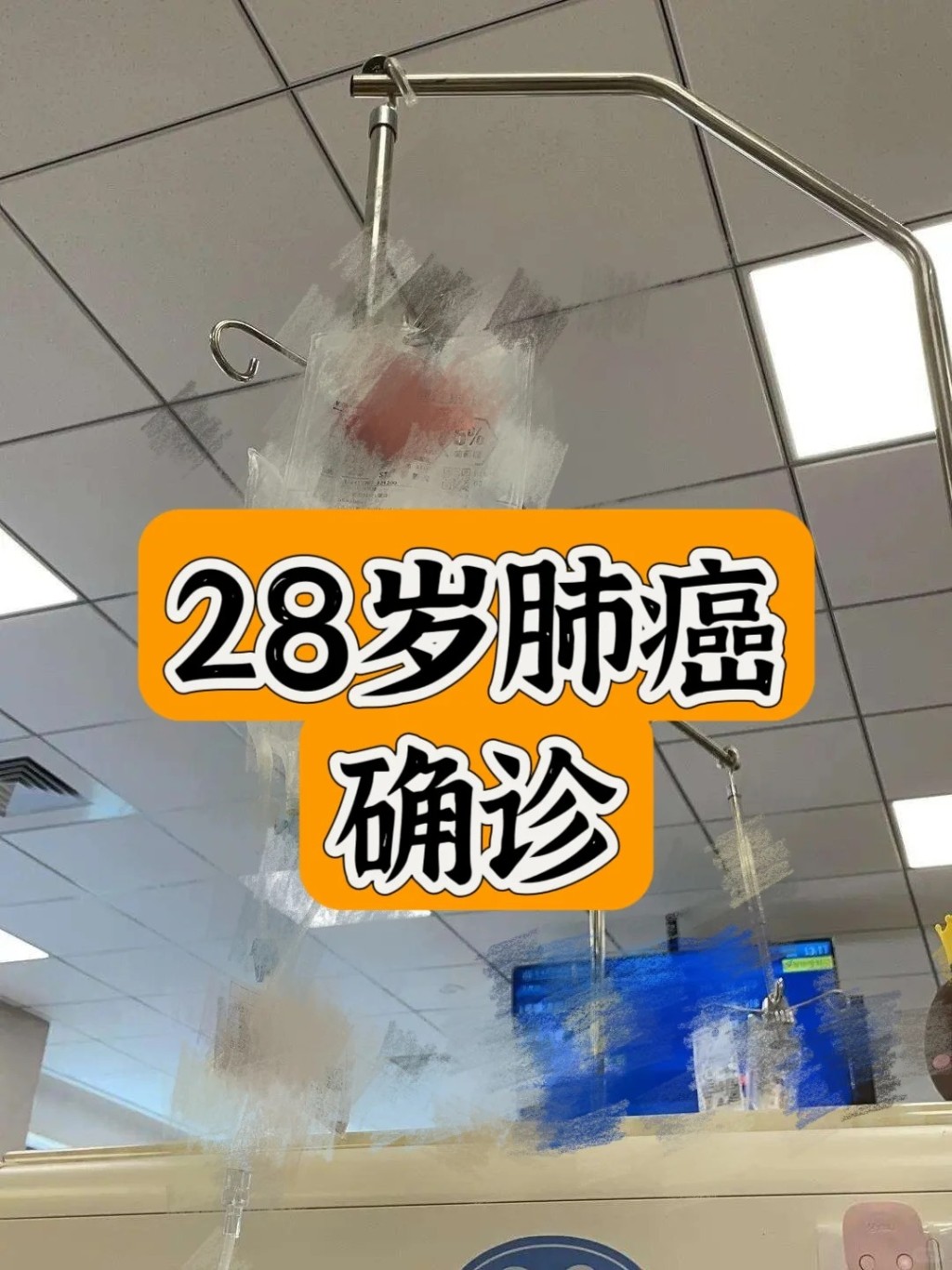 28岁男子表示，自己最早出现的徵兆是咳嗽。（图片来源：小红书「三石」）