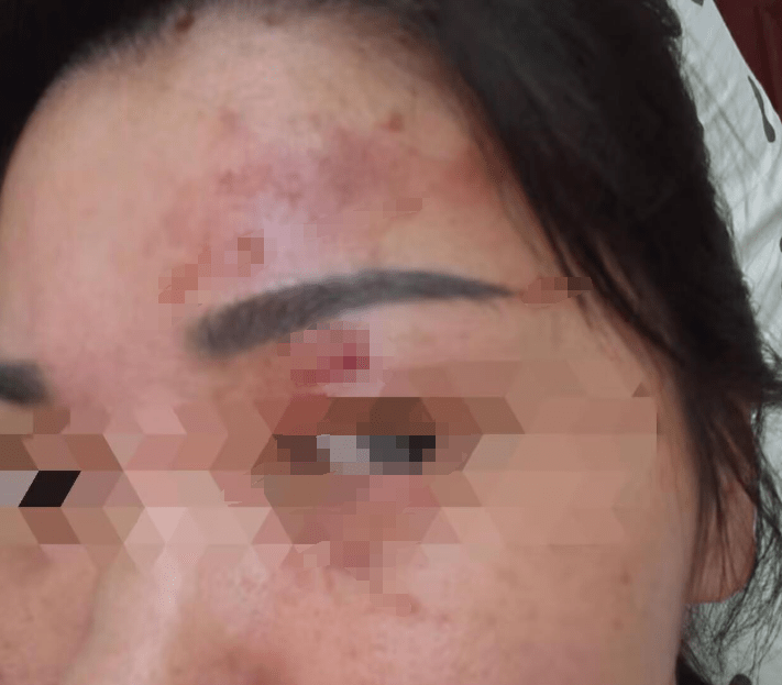 安徽女子用疏通劑清理管道,遭噴濺液體燒傷眼角膜。極目新聞 安徽女子用疏通劑清理管道,遭噴濺液體燒傷眼角膜。極目新聞