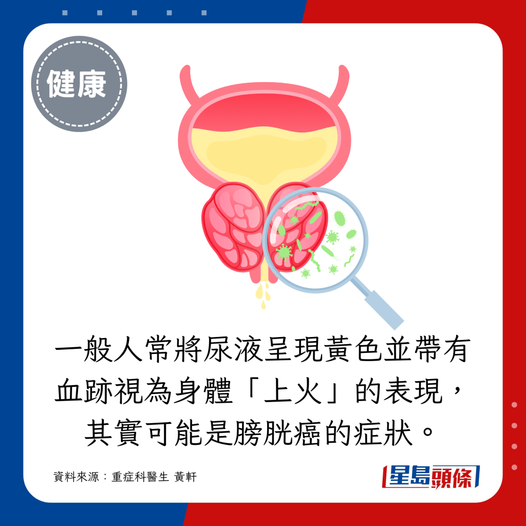 一般人常將尿液呈現黃色並帶有血跡視為身體「上火」的表現，其實可能是膀胱癌的症狀。